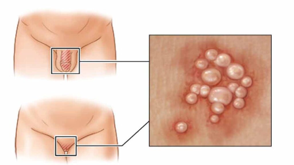 Genital-Herpes-Sexually-Transmitted-Infection