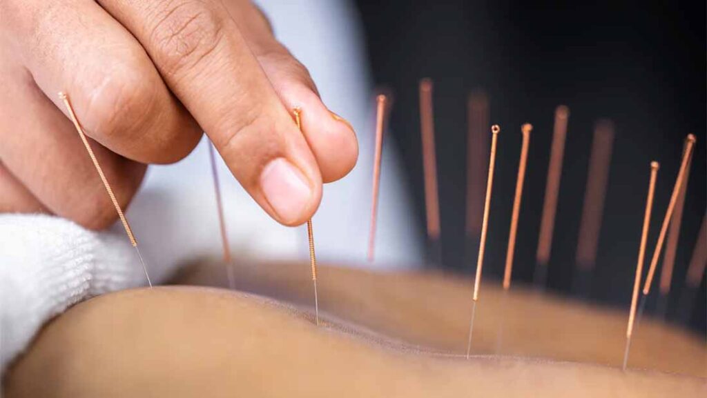 Is-Acupuncture-Right-For-You