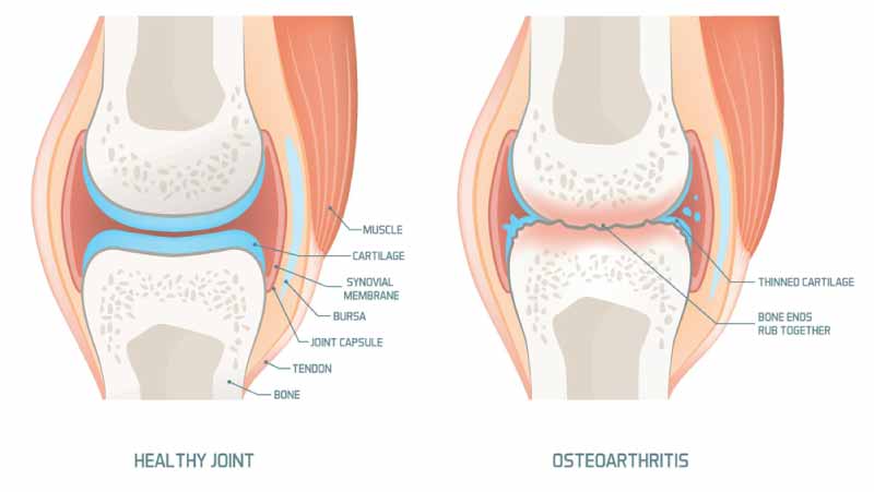 Osteoarthritis-What-it-is,-symptoms-and-treatment