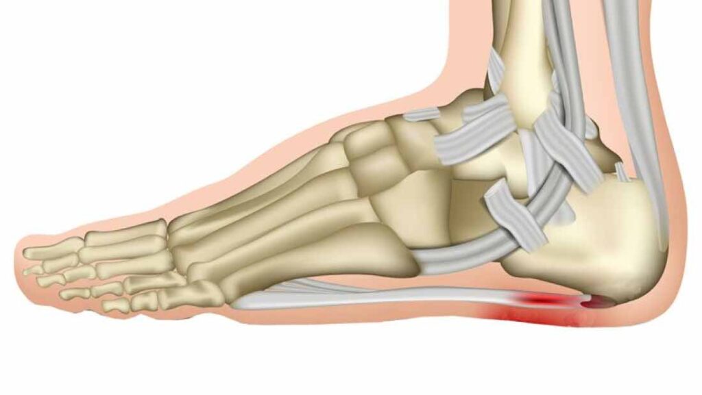 Plantar-Fasciitis-Causes,-Symptoms-and-Treatment