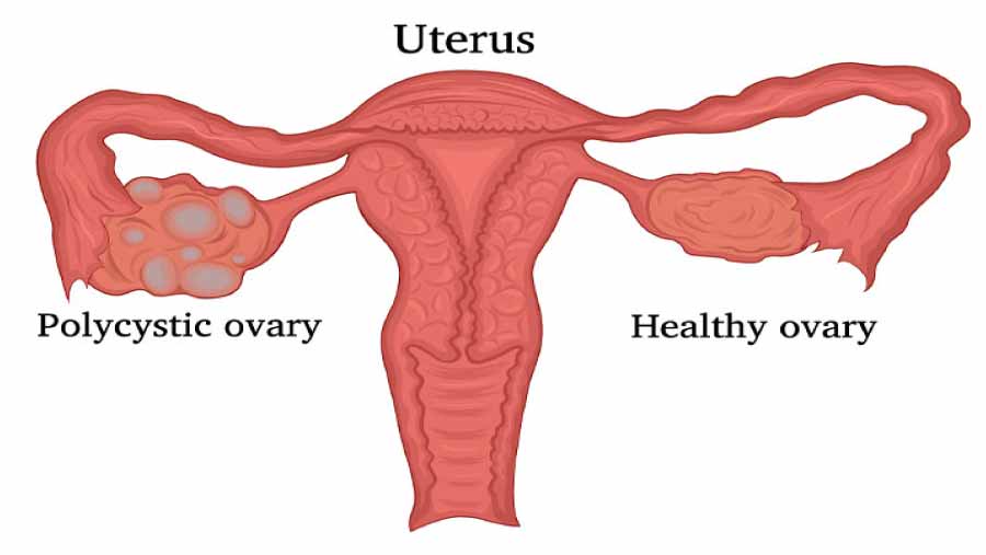 Polycystic-Ovary-Causes,-symptoms-and-treatment