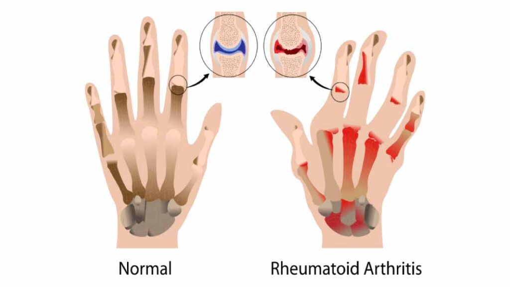 Rheumatoid-Arthritis-Causes,-Symptoms-and-Treatment