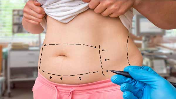 Liposuction: Everything You Need to Know About Surgery