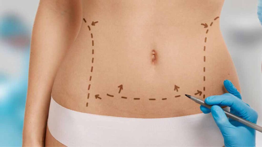 Laser Liposuction: Everything You Need to Know